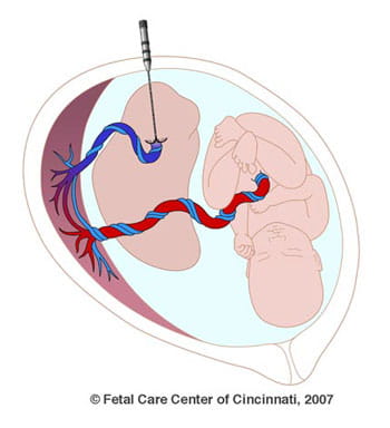 Twin-Reversed Arterial Perfusion / TRAP Sequence | Fetal Care Center